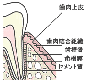 歯周病